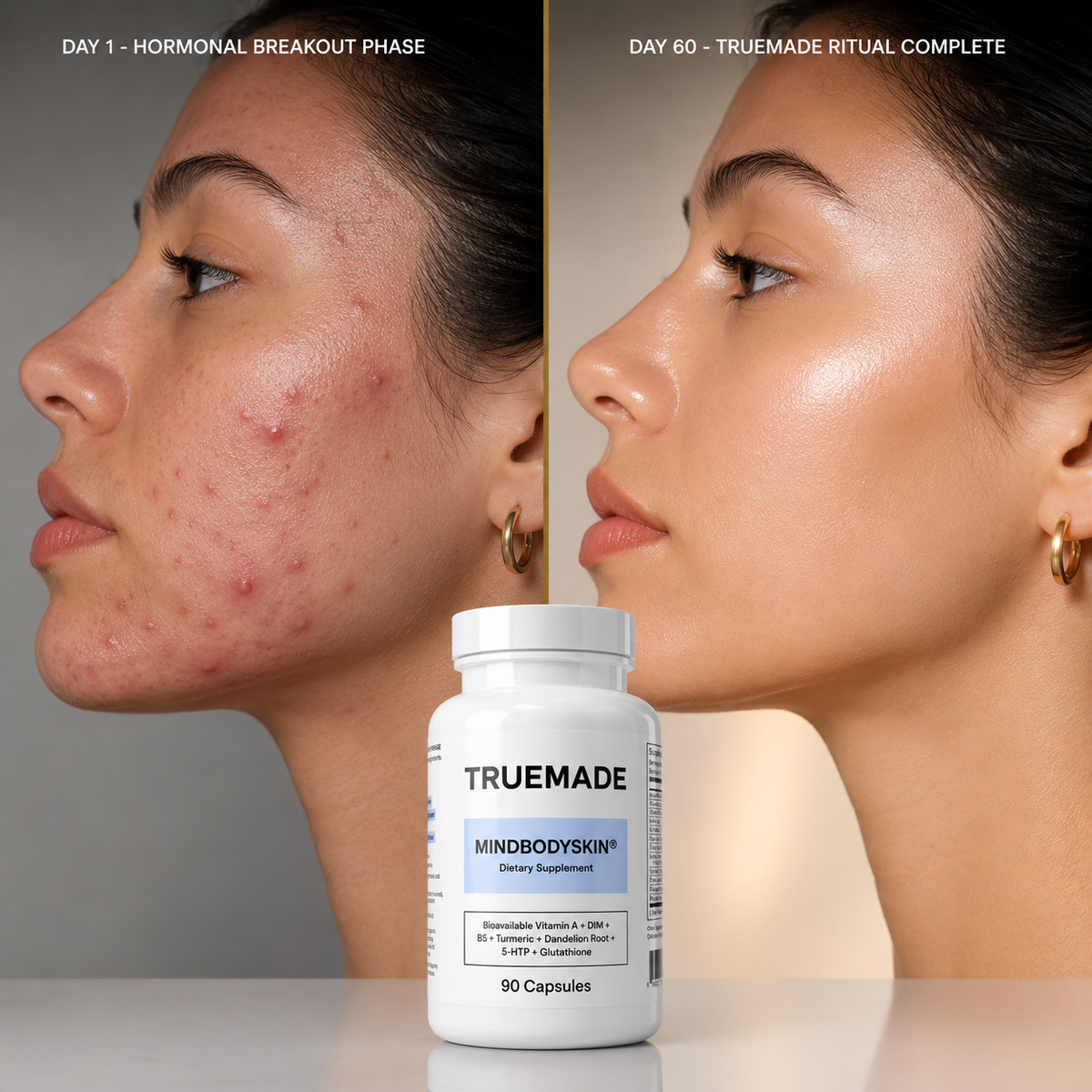 TRUEMADE™ Hormonal Acne Supplement